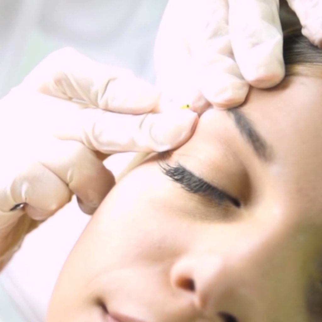 l'electrolyse de carole Electrolyse chez Brigitte Beauté